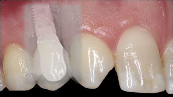 apres parodontie et implantologie paris 11 implantologie dentaire paris docteur gregoire chevalier dr clementine andrieu dr alexandre courtet cabinet parodontie paris 11