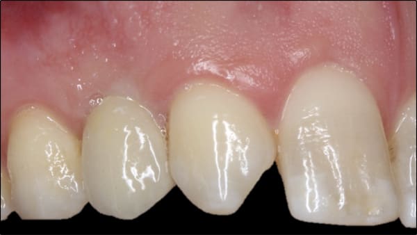 avant parodontie et implantologie paris 11 implantologie dentaire paris docteur gregoire chevalier dr clementine andrieu dr alexandre courtet cabinet parodontie paris 11