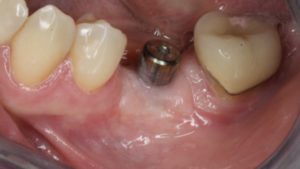 crete edente deplacement lambeau implant dentaire chirurgie implantaire implantologie parodontie dr chevalier dr andrieu dr courtet cabinet parodontie paris 11