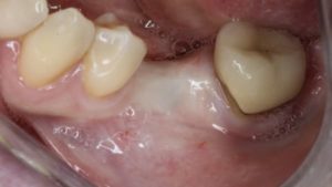 crete edente implant dentaire implantologie parodontie dr chevalier dr andrieu dr courtet cabinet parodontie paris 11