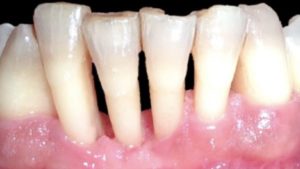 extraction dentaire atraumatique dent guerie parodontite dr chevalier dr andrieu dr courtet cabinet parodontie paris 11