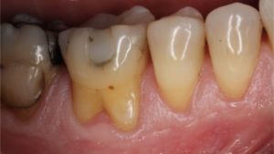 furcation molaire comment se passe un bilan parodontal complet dr chevalier dr andrieu dr courtet cabinet parodontie paris 11