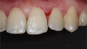 gencive qui saigne saignement gencives parodontite photo parodontite symptomes parodontite paris docteur chevalier cabinet parodontie paris 11