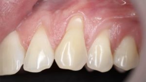 gencive qui se retracte retractation gencives parodontite photo parodontite symptomes parodontite paris docteur chevalier cabinet parodontie paris 11