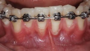 greffe epithelio conjonctive greffe conjonctif enfoui traitement orthodontique dr chevalier dr andrieu dr courtet cabinet parodontie paris 11