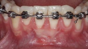 greffe epithelio conjonctive greffe conjonctif enfoui traitement orthodontique resultat dr chevalier dr andrieu dr courtet cabinet parodontie paris 11