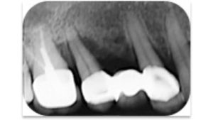 greffe osseuse dentaire lesion intra osseuse avant greffe osseuse dr chevalier dr andrieu dr courtet cabinet parodontie paris 11