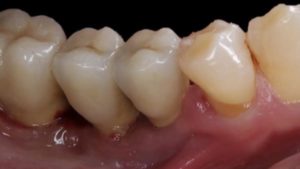 mucosite bouche peri implantite que faire peri implantite symptomes dechaussement dentaire dr chevalier dr andrieu dr courtet cabinet parodontie paris 11