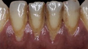 parodontite recession parodontale traitement dechausssement dentaire recession gingivale dr chevalier dr andrieu dr courtet cabinet parodontie paris 11