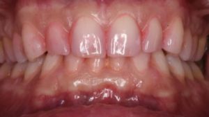 plaque dentaire utilisation revelateur plaque dentaire dr chevalier dr andrieu dr courtet cabinet parodontie paris 11