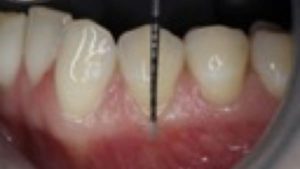 poche parodontale photo comment se passe un bilan parodontal complet dr chevalier dr andrieu dr courtet cabinet parodontie paris 11