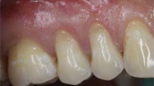 recession parodontale avec lesion cervicale non carieuse composite dechausssement dentaire cabinet parodontie paris 11