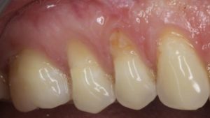 recession parodontale avec lesion cervicale non carieuse traitement dechausssement dentaire cabinet parodontie paris 11
