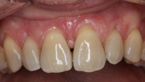 situation dentaire apres traitement paro ortho dr chevalier dr andrieu dr courtet cabinet parodontie paris 11