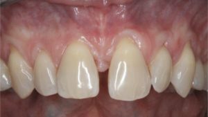 situation dentaire avant traitement paro ortho dr chevalier dr andrieu dr courtet cabinet parodontie paris 11