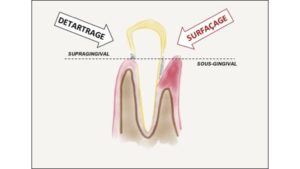 surfacage radiculaire dentaire surfacage radiculaire prix detartrage dr chevalier dr andrieu dr courtet cabinet parodontie paris 11
