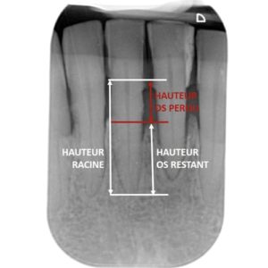 bilan radio long cone parodontite perte osseuse dr chevalier dr andrieu dr courtet cabinet parodontie paris 11 parodontiste paris