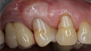 greffe epithelio conjonctive recession parodontale impact esthetique traitement dechausssement dentaire cabinet parodontie paris 11