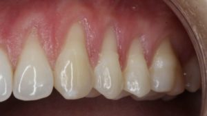 greffe gencive recouvrement recession parodontale impact esthetique traitement dechausssement dentaire cabinet parodontie paris 11 parodontiste paris