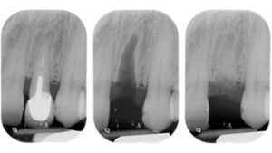 greffe osseuse dentaire lesion intra osseuse avant greffe osseuse dr chevalier dr andrieu dr courtet cabinet parodontie paris 11 parodontiste paris
