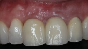 implant dentaire implantologie parodontie esthetique dr chevalier dr andrieu dr courtet cabinet parodontie paris 11 parodontiste paris