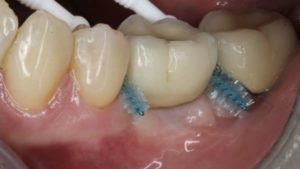 implant dentaire passage brossette implant posterieur dr chevalier dr andrieu dr courtet cabinet parodontie paris 11