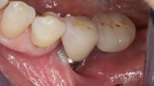 implant sans gencive implant dentaire implantologie parodontie dr chevalier dr andrieu dr courtet cabinet parodontie paris 11