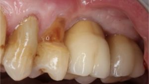 lesion cervicale non carieuse recession parodontale impact esthetique traitement dechausssement dentaire cabinet parodontie paris 11 parodontiste paris