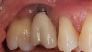 peri implantite que faire peri implantite traitement dechaussement dentaire dr chevalier dr andrieu dr courtet cabinet parodontie paris 11 parodontiste paris