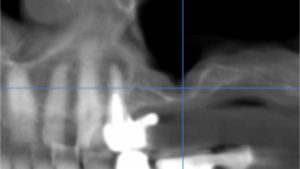 perte osseuse implant dentaire implantologie parodontie dr chevalier dr andrieu dr courtet cabinet parodontie paris 11 parodontiste paris