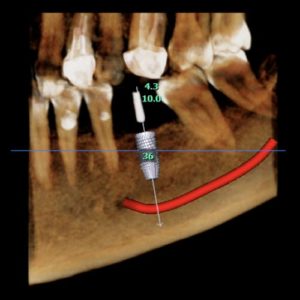 radio 3d cone beam planification implantaire dr chevalier dr andrieu dr courtet cabinet parodontie paris 11