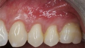recession parodontale impact esthetique traitement dechausssement dentaire dr chevalier dr andrieu dr courtet cabinet parodontie paris 11 parodontiste paris