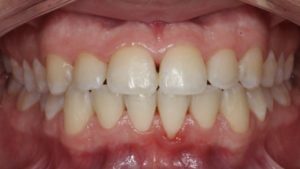 triangles noirs dents surfacage radiculaire dentaire surfacage radiculaire detartrage dr chevalier dr andrieu dr courtet cabinet parodontie paris 11 parodontiste paris