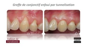 recouvrement radiculaire greffe conjonctif enfoui docteur gregoire chevalier associes parodontiste paris