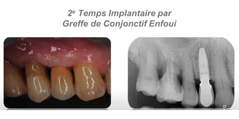 2eme temps implantaire par greffe de conjonctif enfoui cabinet gregoire chevalier parodontie paris