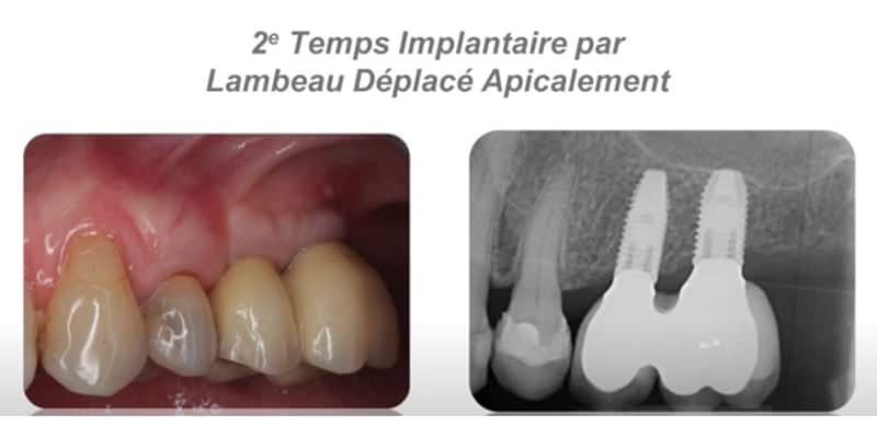 2eme temps implantaire par lambeau deplace apicalement cabinet gregoire chevalier parodontie paris