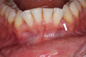 inflammation pma parodontie traitement cause parodontopathies parodontiste paris cabinet gregoire chevalier parodontie paris 11