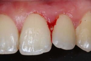 saignements spontanes dentaires gencive traitement parodontiste cabinet gregoire chevalier parodontie paris 11