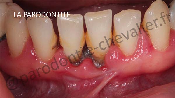 parodontite et diabete parodontite aliments a eviter traitement symptomes parodontiste cabinet gregoire chevalier parodontie paris 11